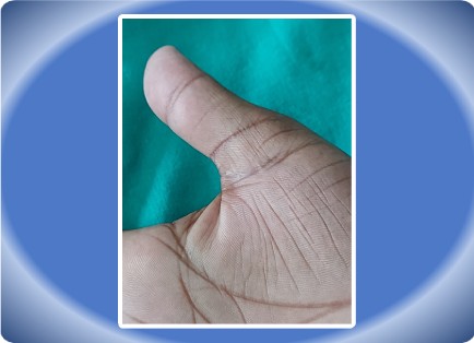 TENDON INJURY